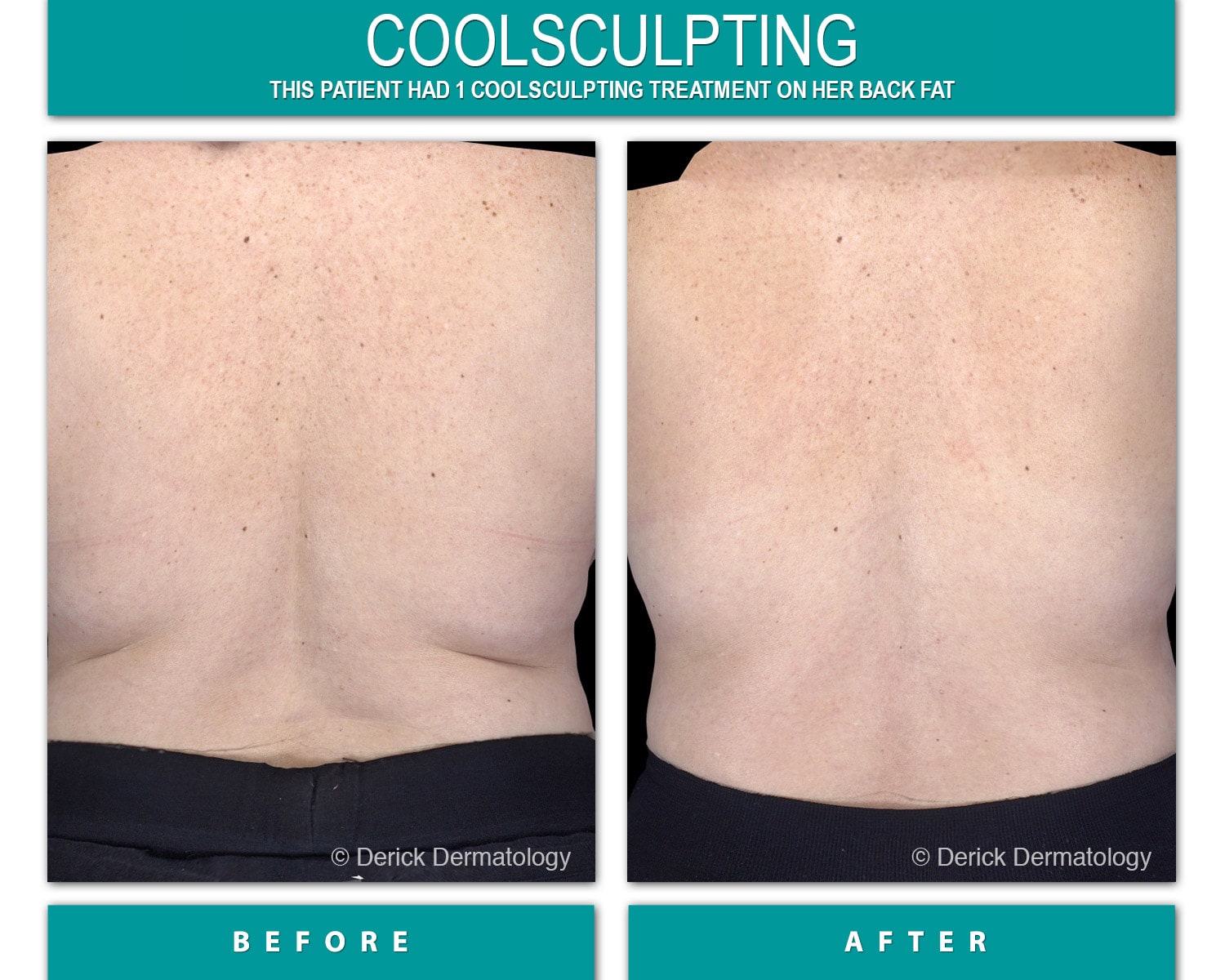 CoolSculpting