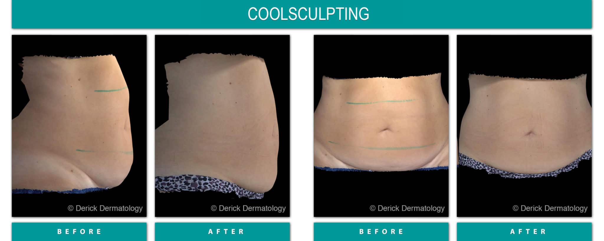 CoolSculpting Before and After CoolSculpting Before and After