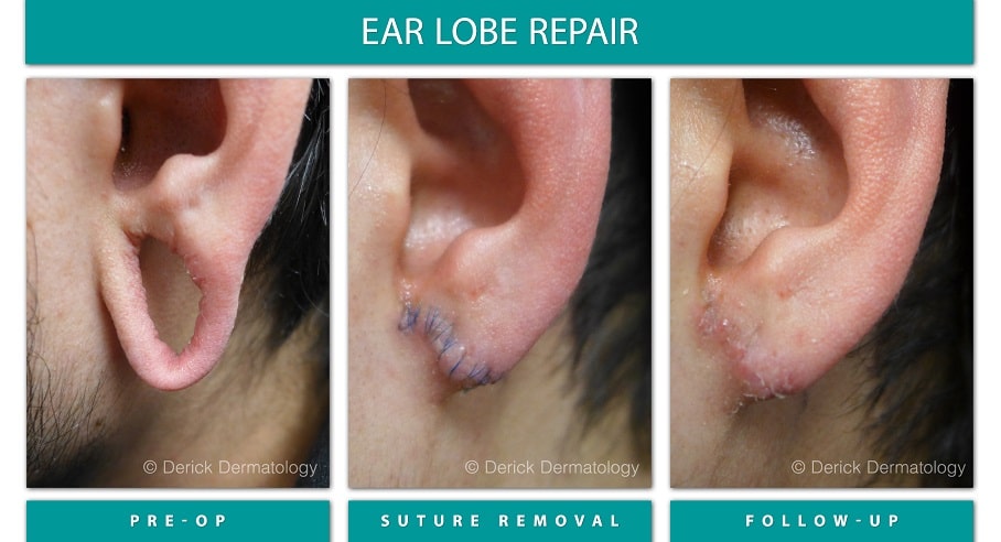 Is Earlobe Repair Right For You?