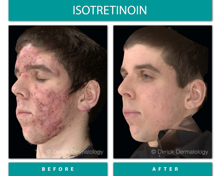 Isotretinoin before and after, right profile showing cleared severe cystic acne on cheek and jaw