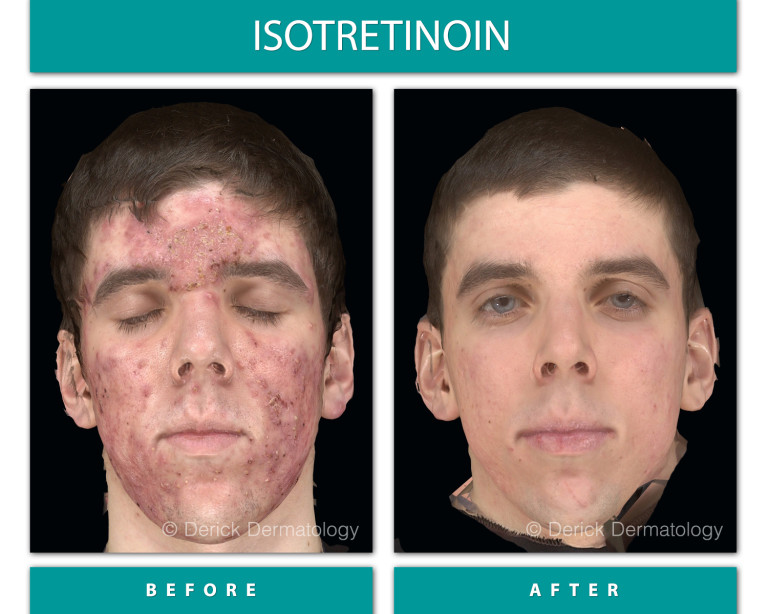 Isotretinoin before and after, front view showing cleared severe cystic acne across full face