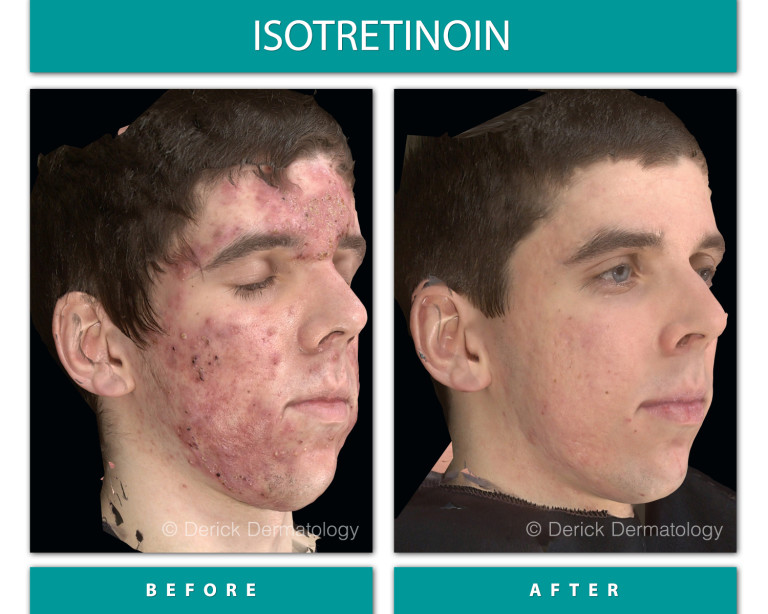 Isotretinoin before and after, left three-quarter view showing cleared severe cystic acne on cheek