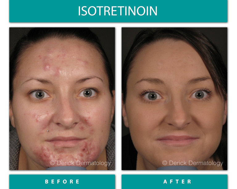 Isotretinoin before and after, front view showing cleared severe acne on cheeks and chin