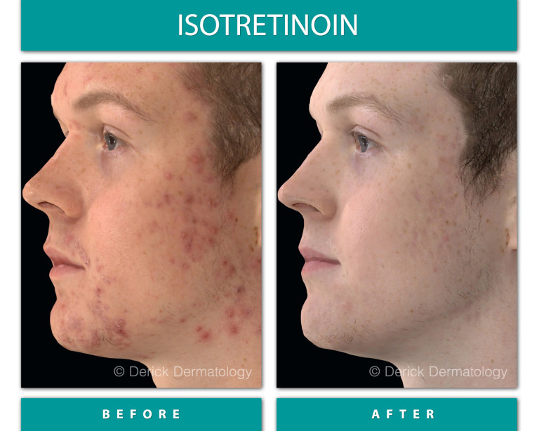 11_ISO_BEFORE-AFTER_1500x1200px.jpg