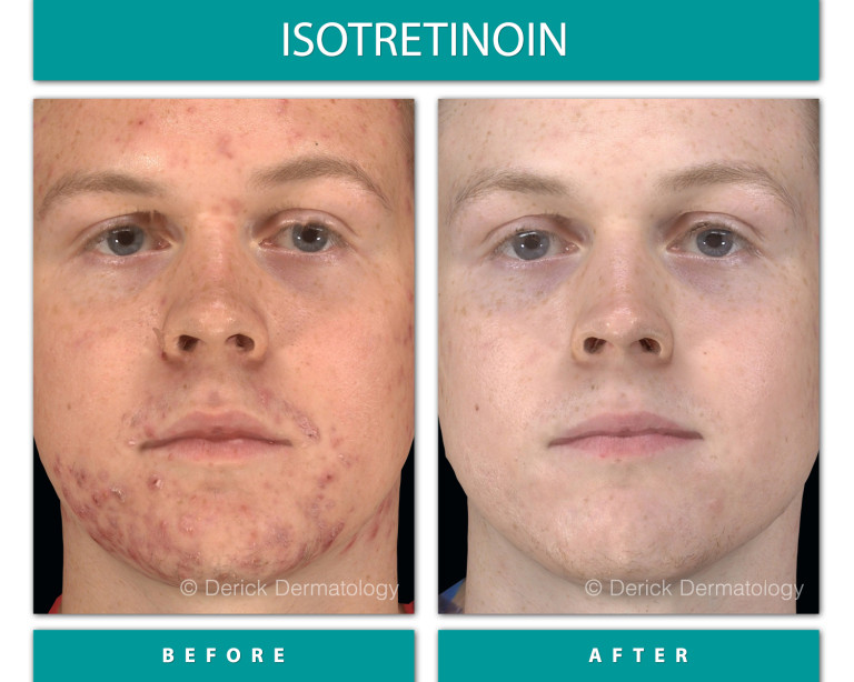 Isotretinoin before and after, left profile showing cleared acne on cheek