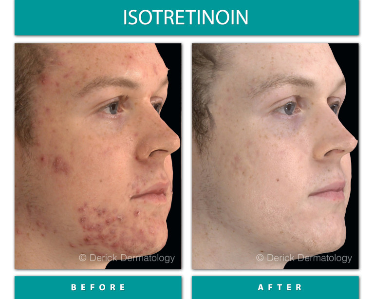 Isotretinoin before and after, right profile showing cleared cystic acne on cheek and ja