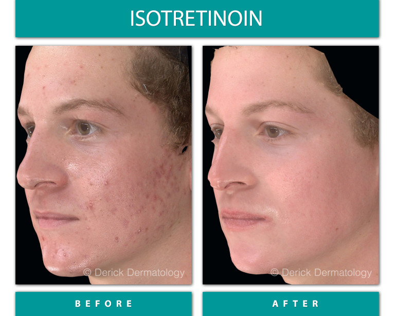Isotretinoin before and after, right three-quarter view showing cleared acne on cheek and jawline