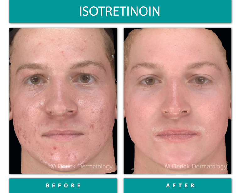 Isotretinoin before and after, front view showing cleared acne on cheeks and chin