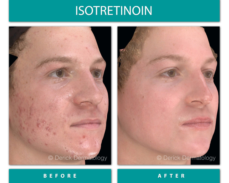 Isotretinoin before and after, left three-quarter view showing cleared acne on cheek