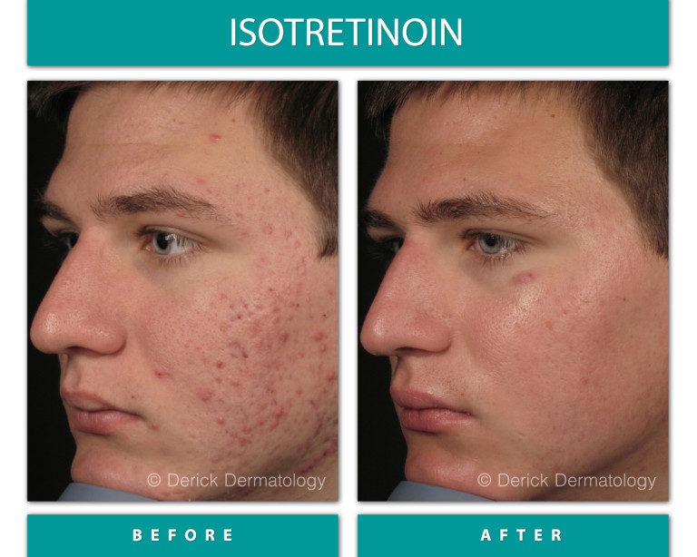 Isotretinoin before and after, right profile showing cleared acne on cheek