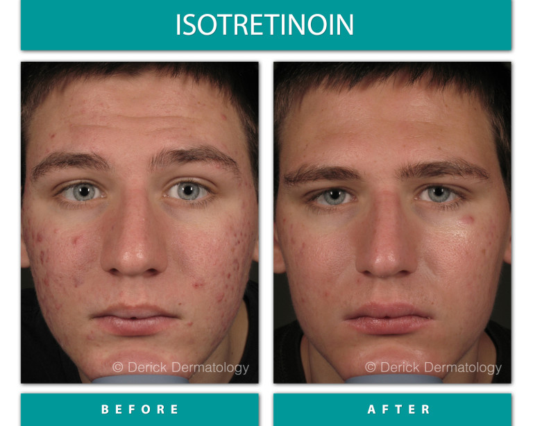 Isotretinoin before and after, front view showing cleared acne on cheeks and forehead