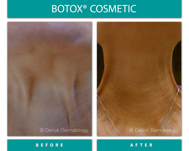 Before and After Image of Botox Cosmetic