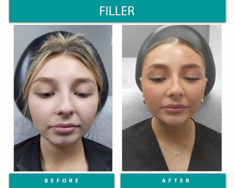 Dermal filler before and after, front view showing enhanced facial contour and lips