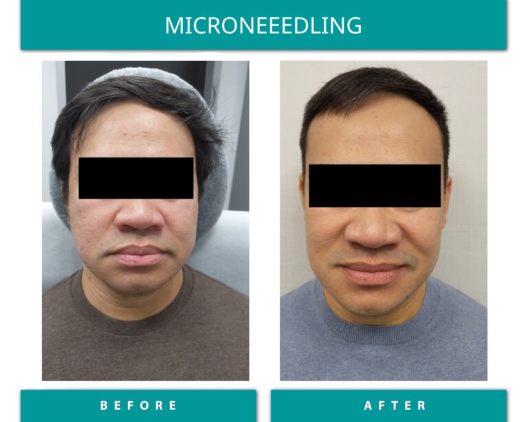 Microneedling before and after