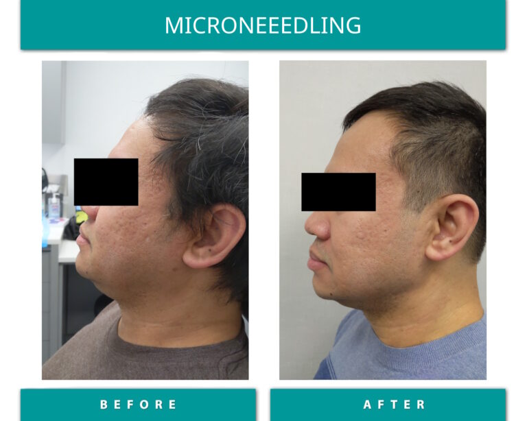Microneedling before and after