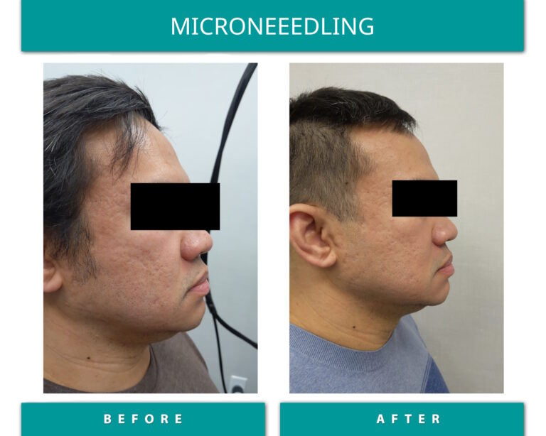 Microneedling before and after