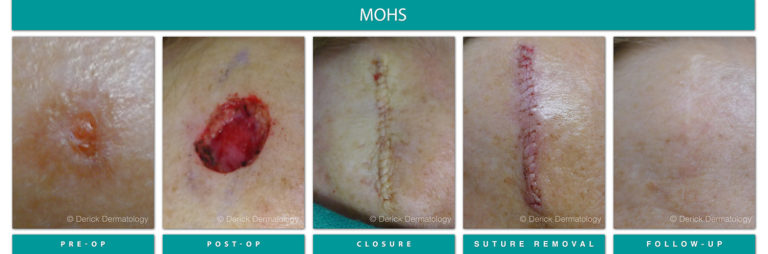Mohs Surgery Chicago, IL