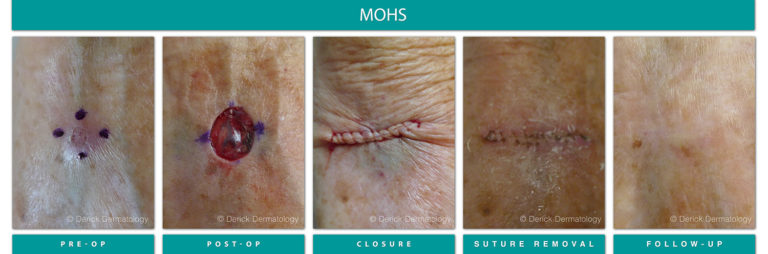 Mohs Surgery Chicago, IL