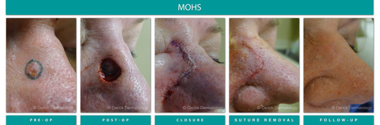Mohs Surgery Chicago, IL