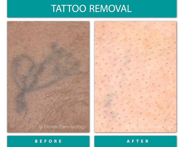 Before and After Image of Tattoo Removal