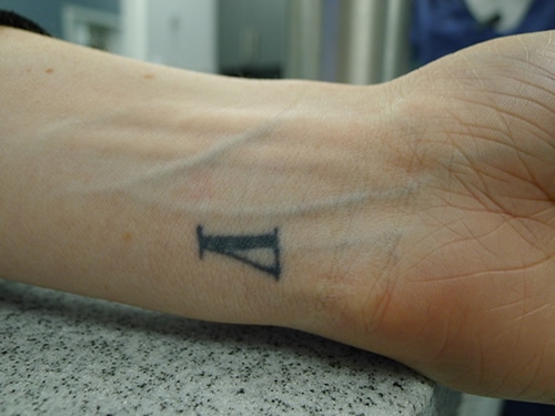 How does laser tattoo removal work?