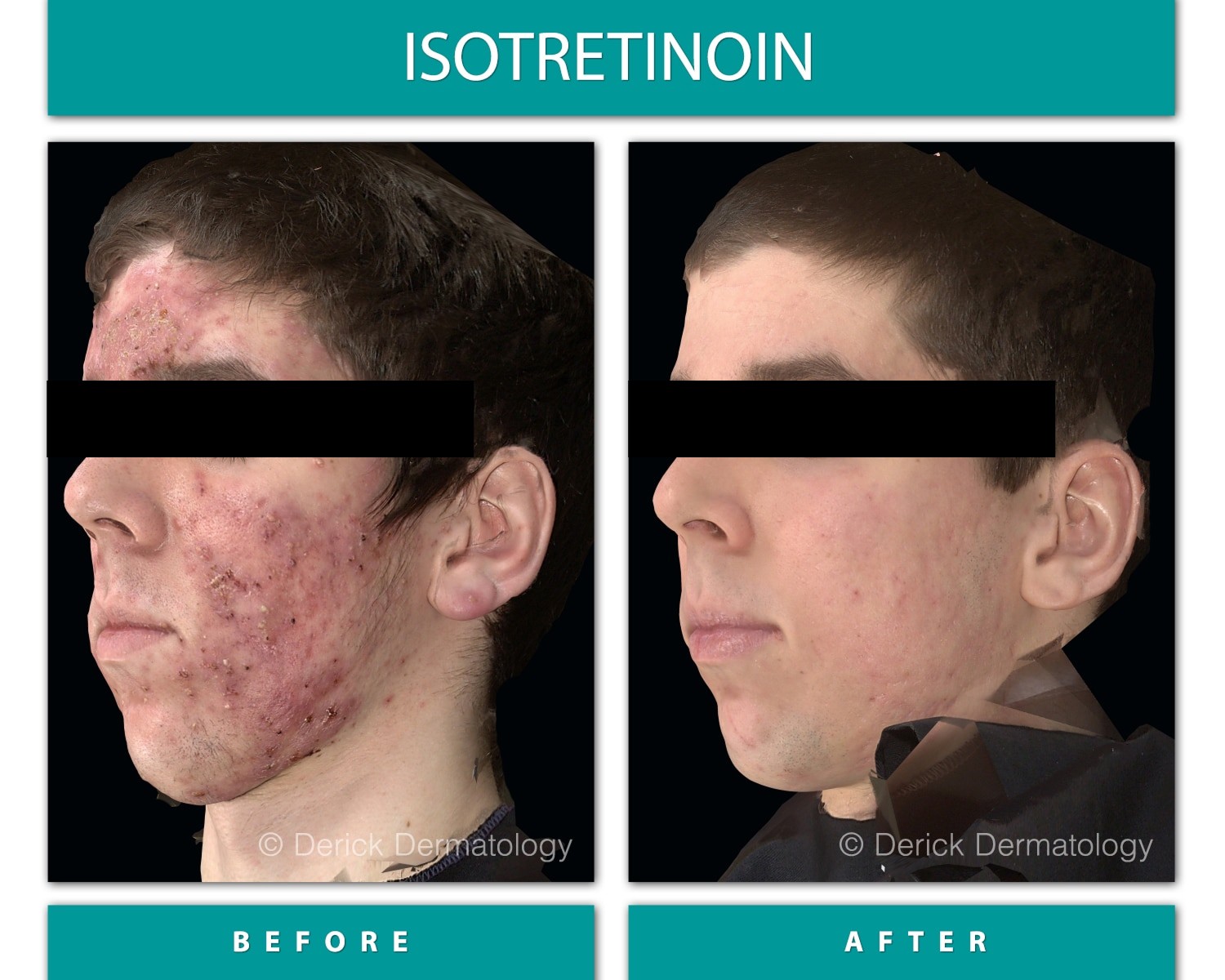 Before and After Image of Acne Treatment (Isotretinoin)