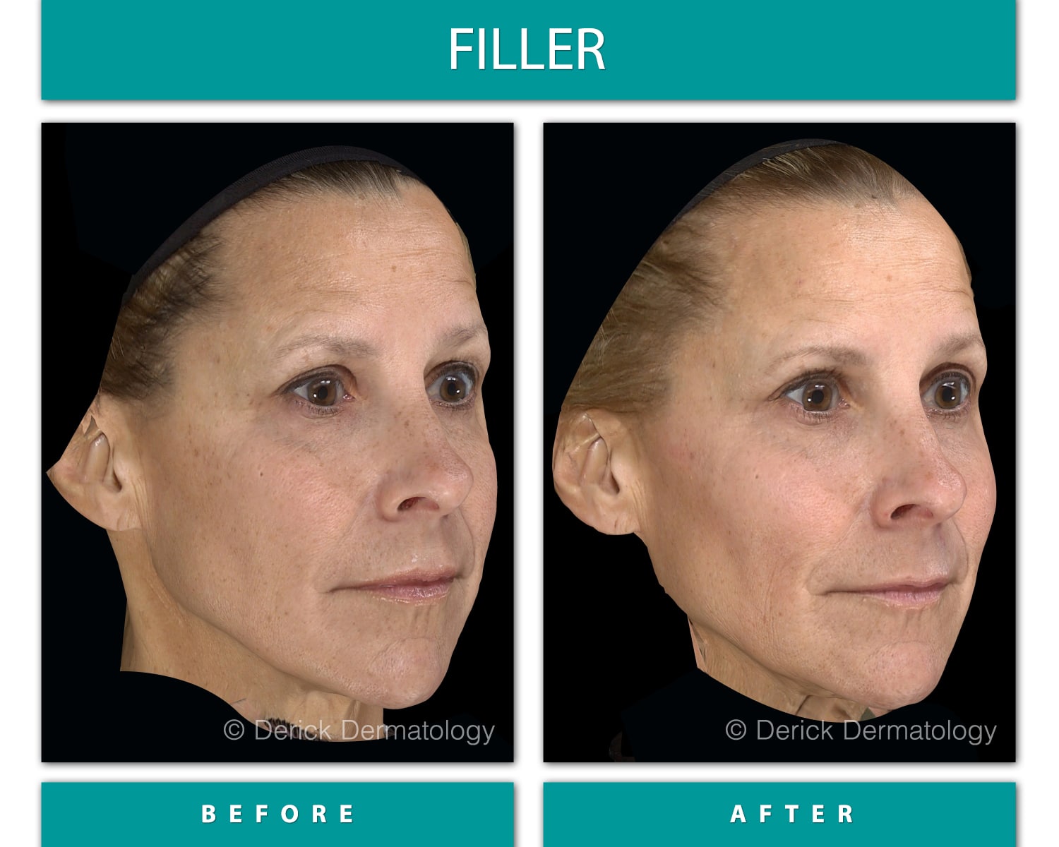 Before and After Image of Filler