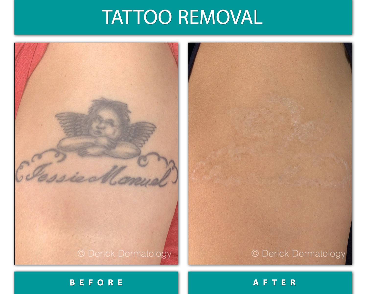 Before and After Image of Tattoo Removal