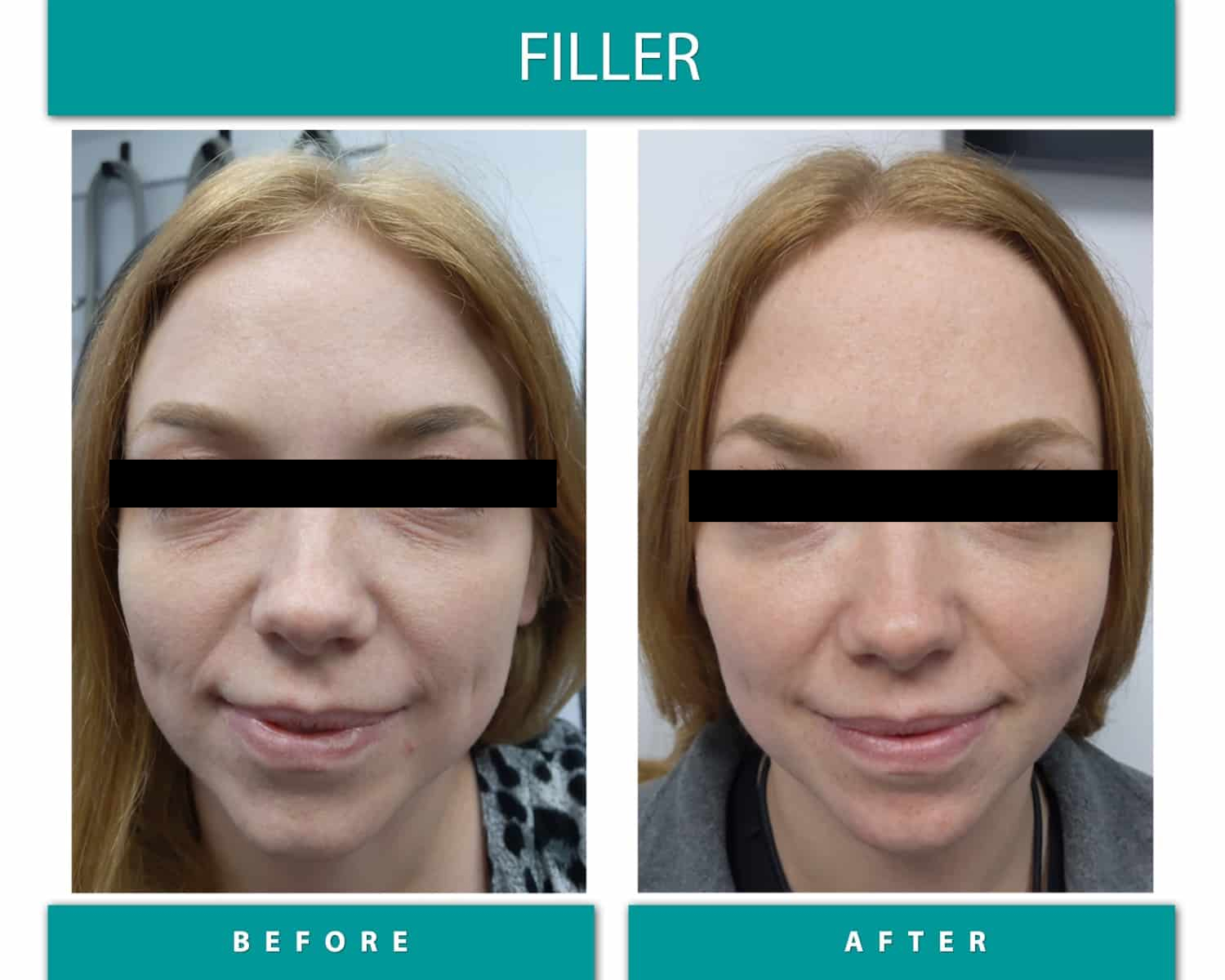Before and After Image of Filler