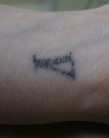Laser Tattoo Removal Update