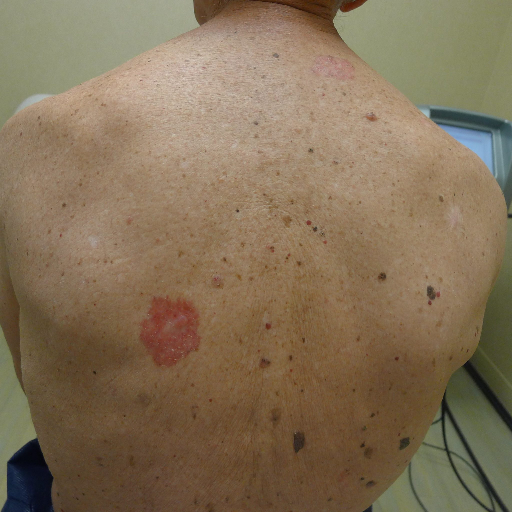 May is Skin Cancer Awareness Month