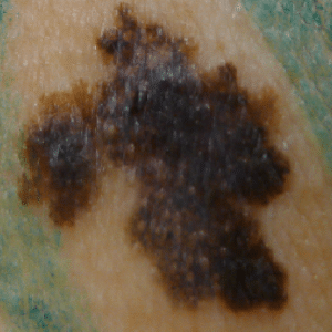 Excision of a Melanoma
