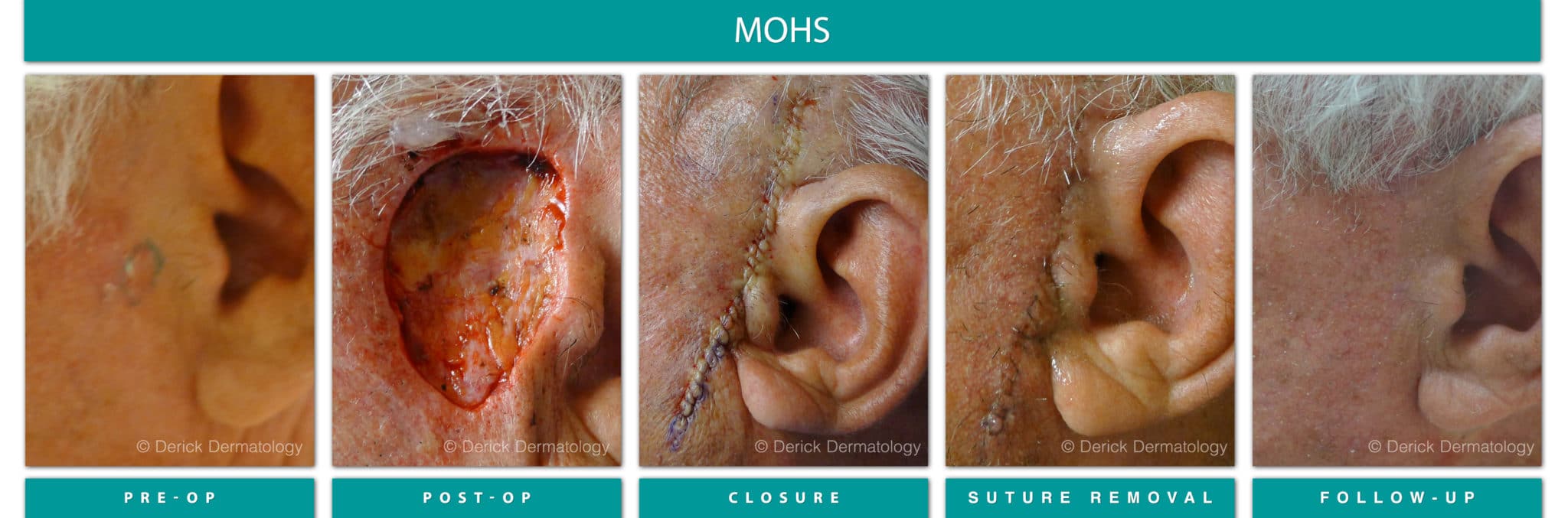 Mohs Surgery