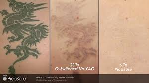 PicoSure Promises Faster Tattoo Removal