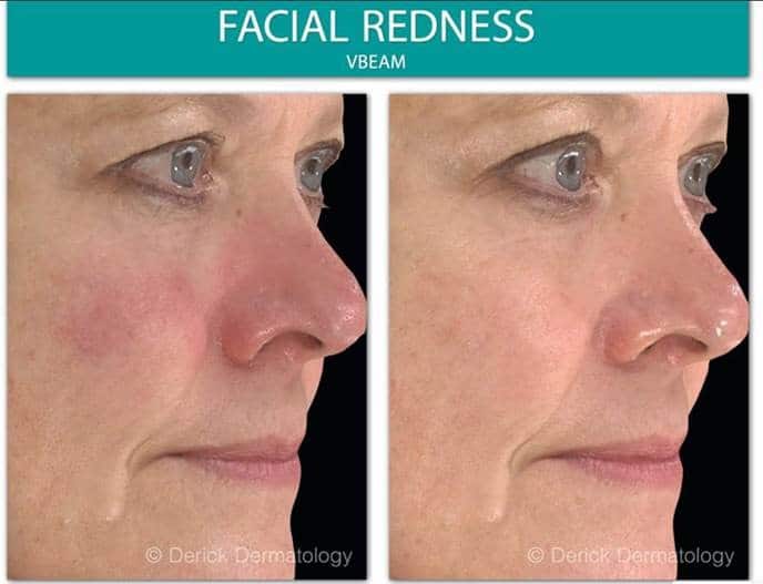 Removing the Redness- Vbeam