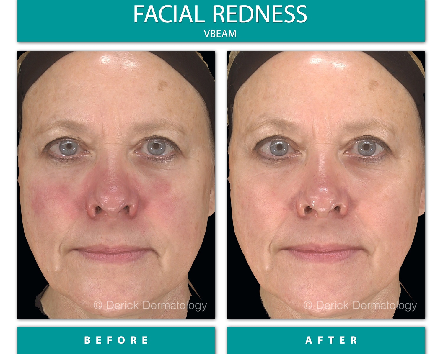 Rosacea and You