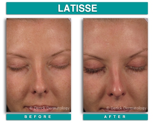 Trade in False Lashes for Latisse